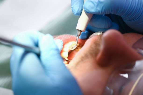 Best Emergency Wisdom Tooth Extraction in Sundown, TX